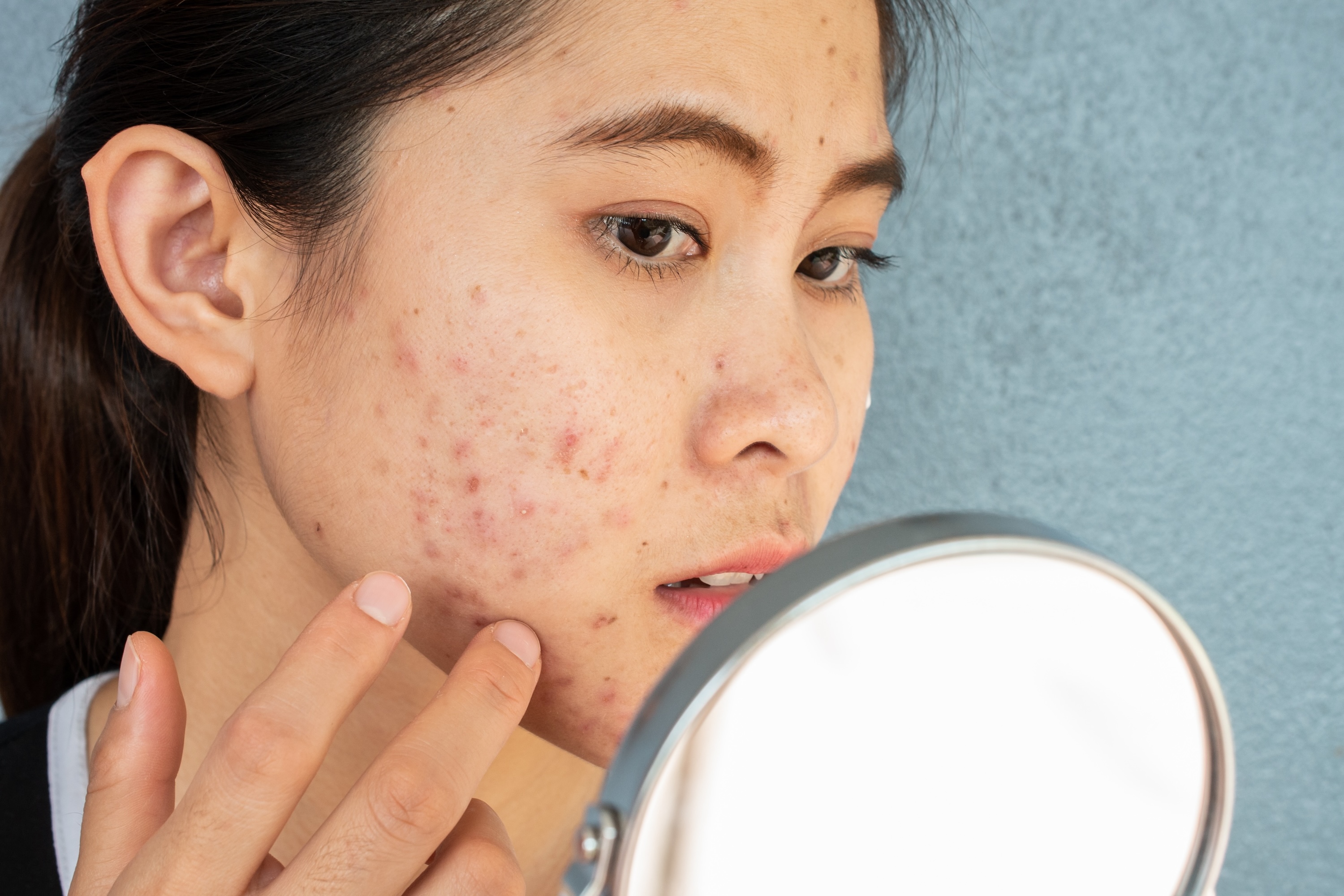 Breaking Out in Your 30s? Here's Everything You Need to Know About Adult Acne and How to Treat It